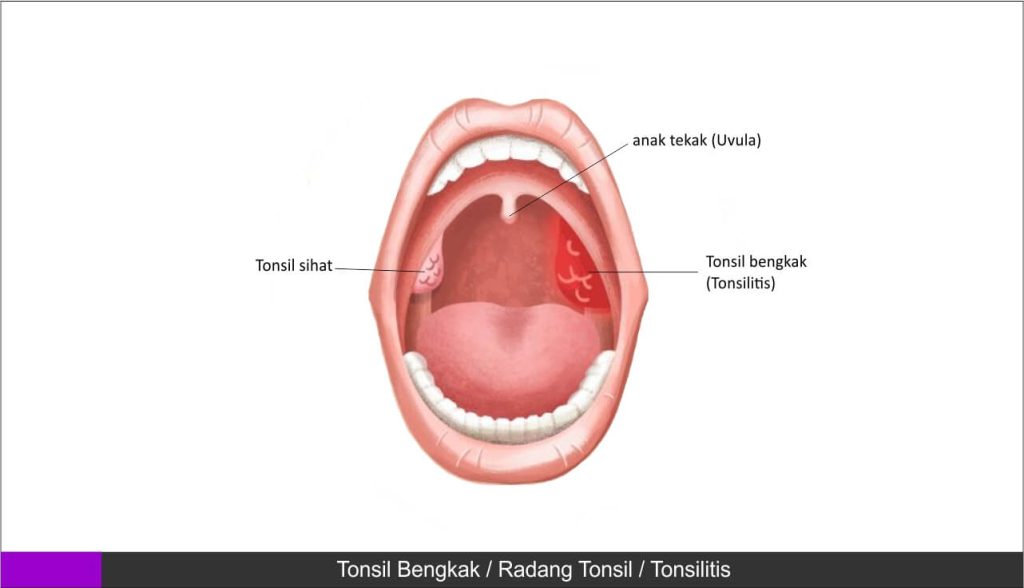 tonsil bengkak